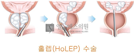 홀랩수술의방법